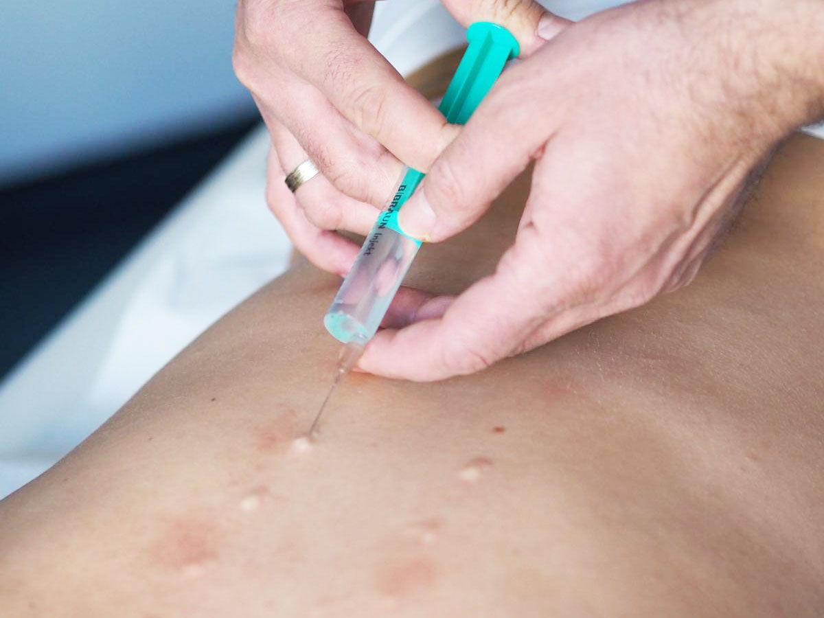 Neuraltherapie nach Huneke